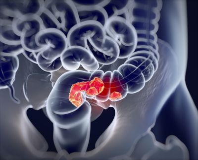 Long-read 16S rRNA amplicon sequencing reveals microbial characteristics in patients with colorectal adenomas and carcinoma lesions in Egypt