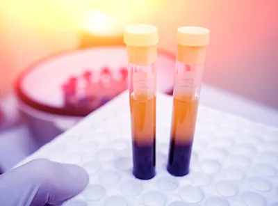 Third-generation nanopore sequencing for post-transplant chimerism monitoring