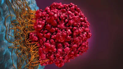 Nanopore sequencing as a cutting-edge technology for medulloblastoma classification
